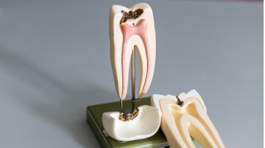 Root canal service in Rogers, AR